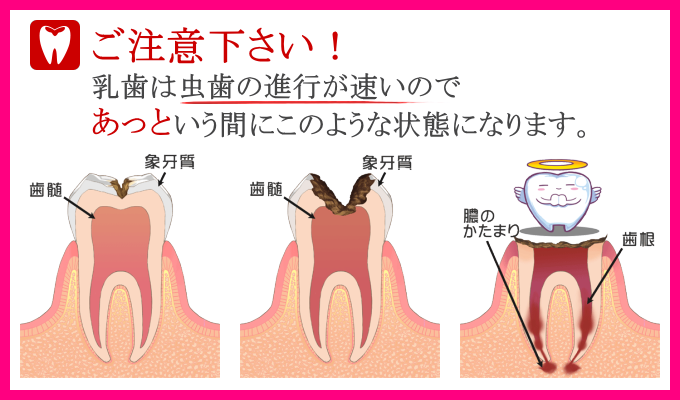 ご注意下さい！乳歯は虫歯の進行が速いのであっという間にこのような状態になります。