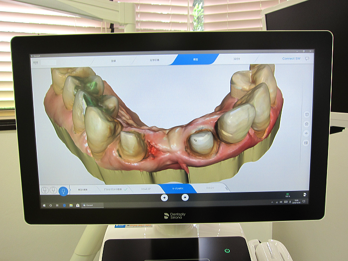 ３Ｄ光学印象口腔内スキャナーの虫歯治療画面