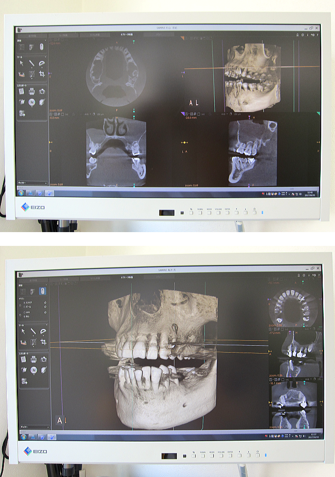 パノラマ・歯科用CT(3D)レントゲン撮影後の写真
