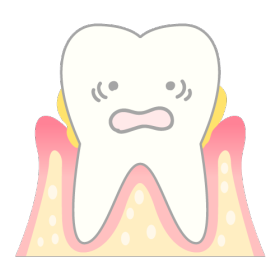 歯周病の初期状態