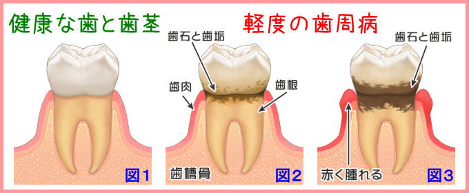 病 歯 症状 周 歯周病の症状の一つ、「骨吸収」とは？