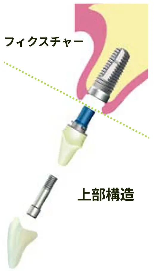 implant