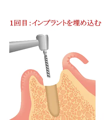 インプラント1回目の手術