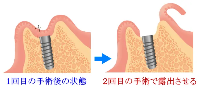 インプラント2回目の手術