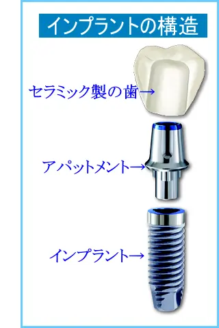 インプラントの構造