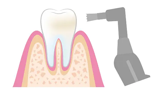 ペーストを塗布