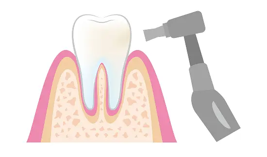 歯の表面をクリーニング