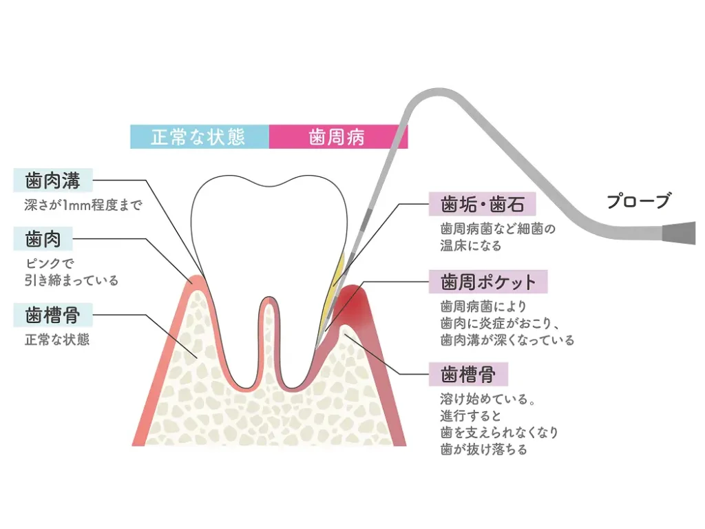 検査1　ポケット測定