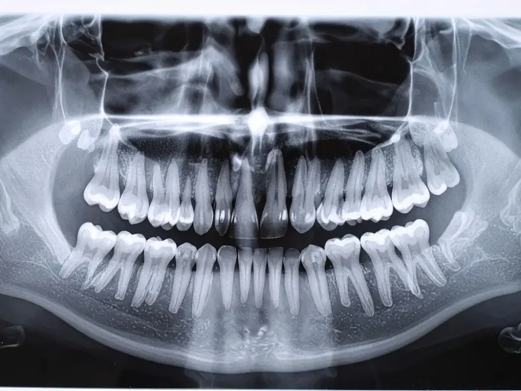 検査5　レントゲン検査（⁨⁩重度の場合）